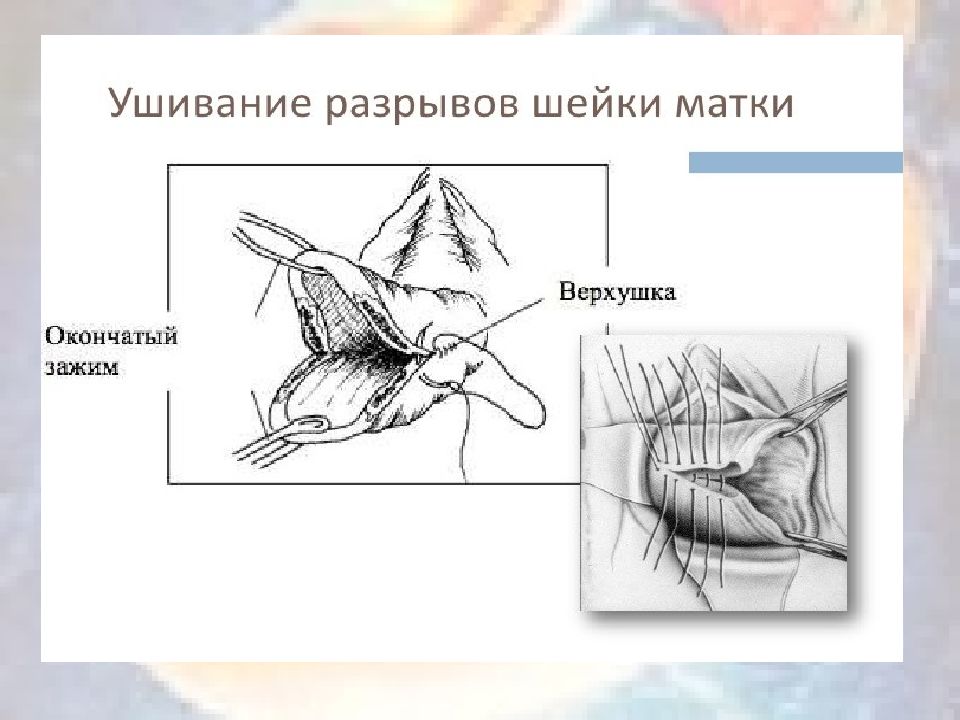 Разрыв матки презентация по акушерству