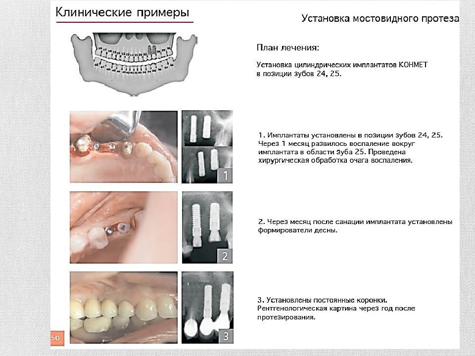 Дентальная имплантация презентация