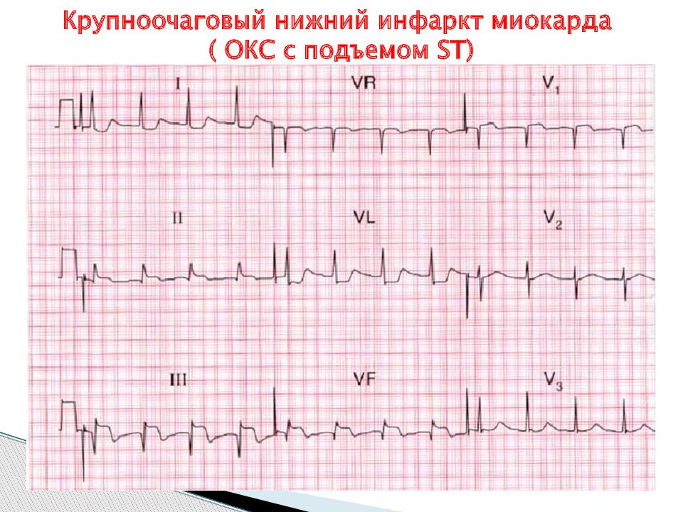 Острый коронарный синдром карта вызова