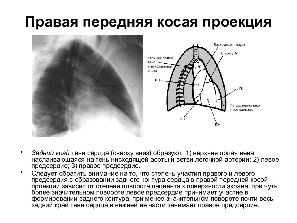 Тени сердца. Левая косая проекция сердца на рентгенограмме. Правая передняя косая проекция. Рентген сердца в правой косой проекции. Правая косая проекция сердца.