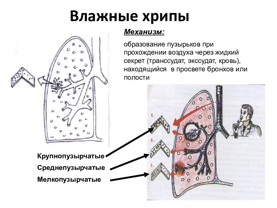 Скрип в легких. Механизмы образования сухих и влажных хрипов схема. Механизм образования сухих хрипов схема. Механизм образования мелкопузырчатых хрипов. Схема возникновения хрипов.