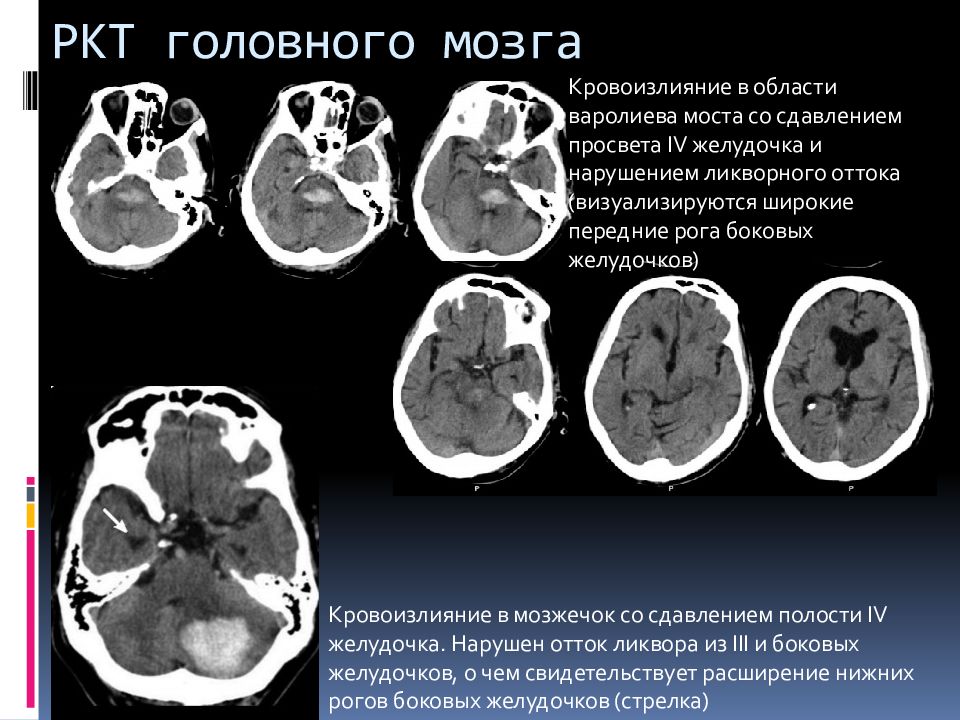 Инсульт кровоизлияние в желудочки