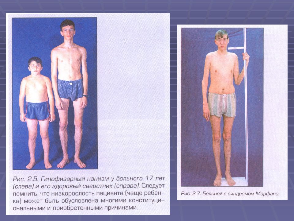 Гипофизарный нанизм. Гипофизарный нанизм (карликовость). Гипофизарная карликовость проявления. Гипофизарная карликовость у детей. Гипофизарный нанизм причины.