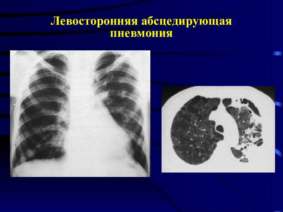 Левосторонняя пневмония. Синдром легочного уплотнения на рентгене. Синдром уплотнения легочной ткани рентген. Уплотнение легочной ткани на рентгене. Абсцедирующая деструктивная пневмония.