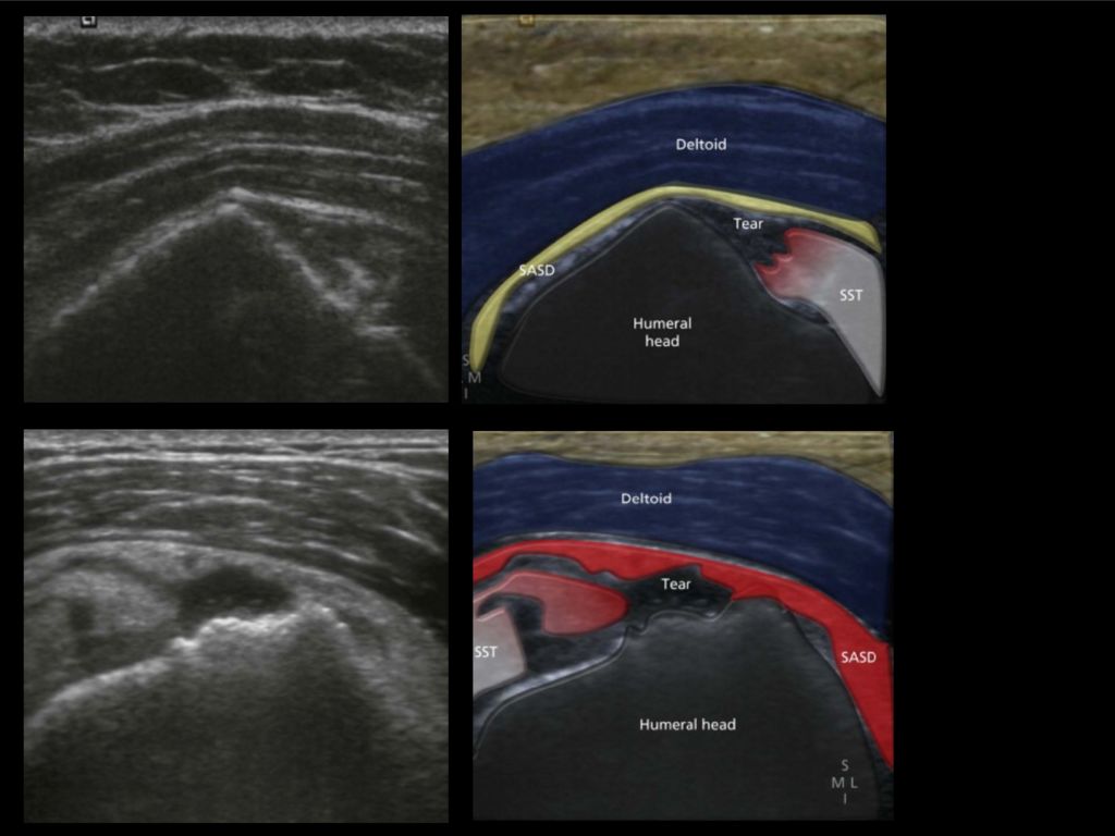 Узи плечевого. УЗИ плечевого сустава методика исследования. УЗИ жидкость в полости плечевого сустава. Сумки плечевого сустава анатомия УЗИ.
