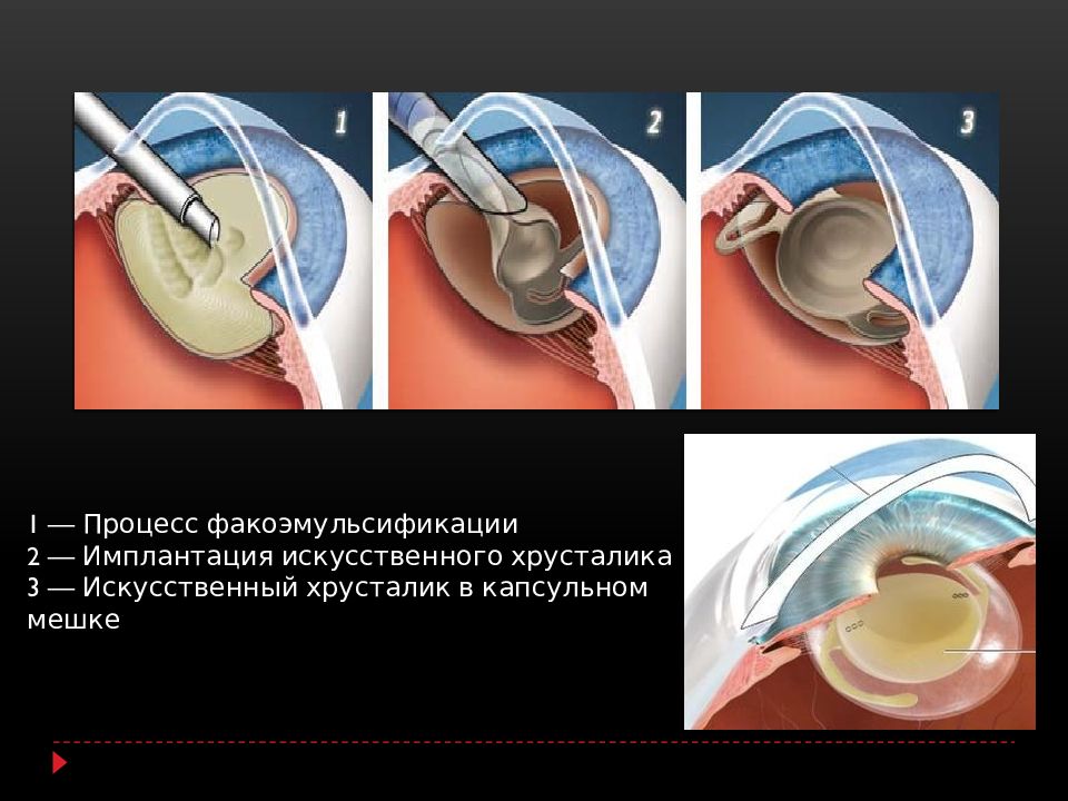 Действие после операции катаракта