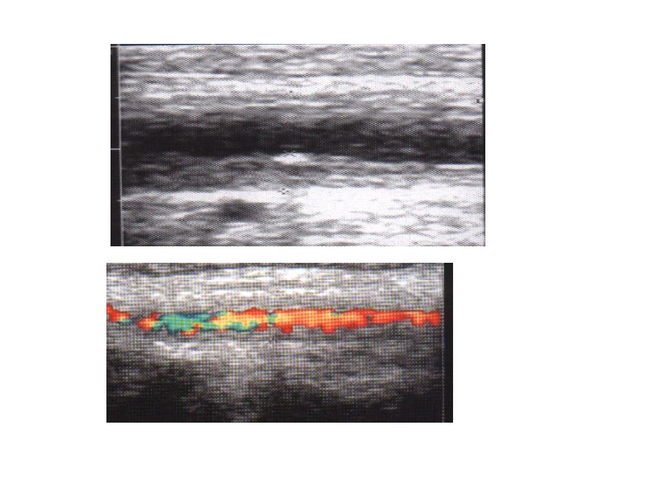 Узи сосудов новокузнецк. Кальцинация сосудов на УЗИ. Эластичные сосуды на УЗИ.