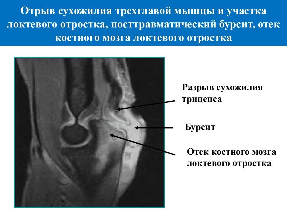 Отек костного мозга латеральных мыщелков. Трабекулярный отек костного мозга мрт. Отрыв локтевого отростка. Отек костного мозга локтевого отростка. Субкортикальный отек костного мозга.