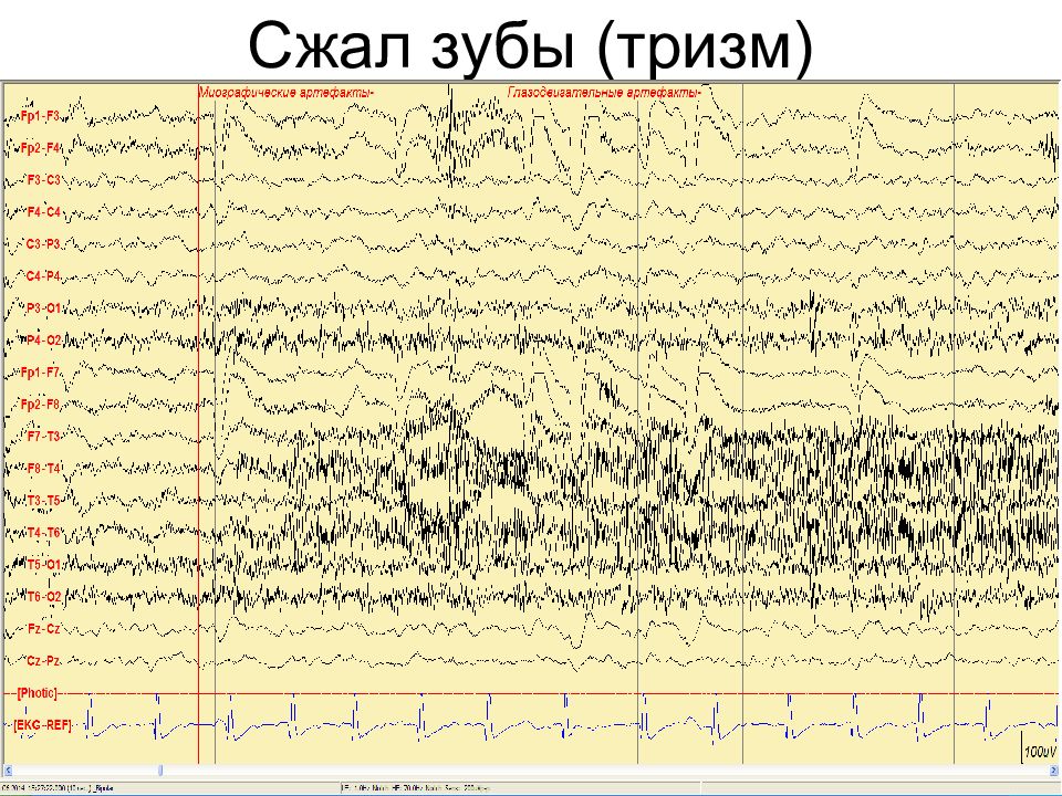 Ээг что это за обследование. Трехфазные волны на ЭЭГ. Артефакты на ЭЭГ тризм. Окуломоторный артефакт на ЭЭГ. ЭЭГ ВМ.