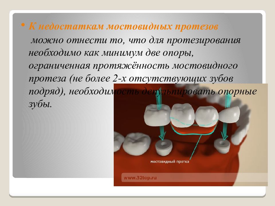 Виды мостовидных протезов. Мостовидные протезы презентация. Недостатки мостовидных протезов. Мостовидный протез показания. Опоры мостовидных протезов.