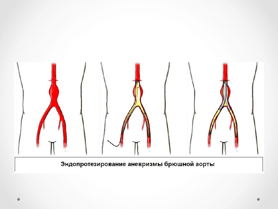 Аневризма брюшной аорты презентация