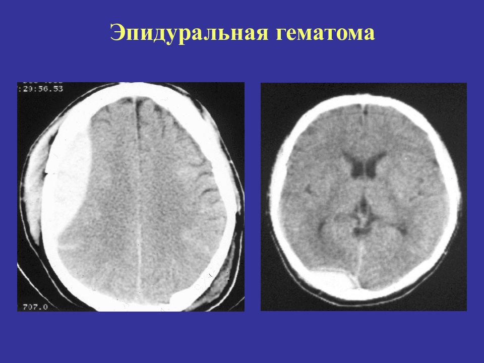 Эпидуральная гематома на кт