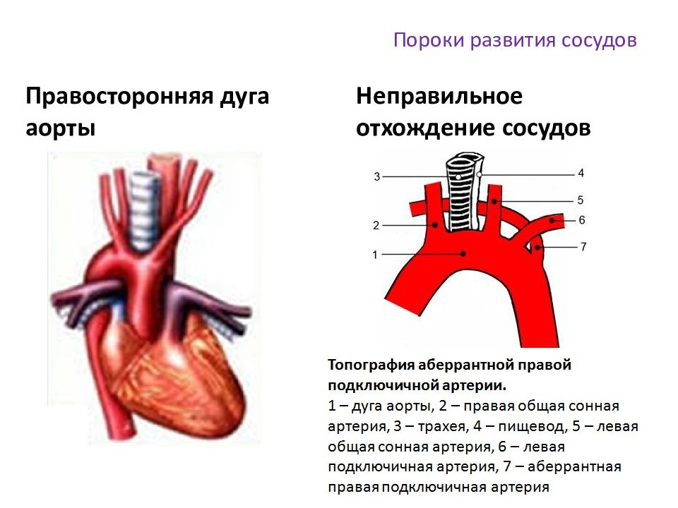Правая аберрантная артерия. Правосторонняя дуга аорты на кт. Праволежащая дуга аорты. Аберрантная правая подключичная артерия. Аномалии сосудов дуги аорты.