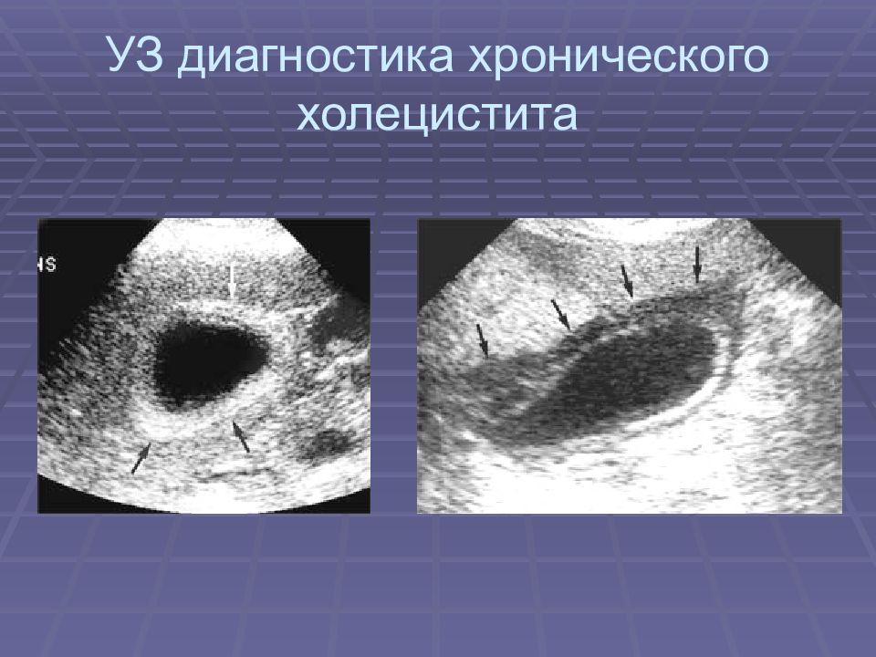 Хронический холецистит план обследования