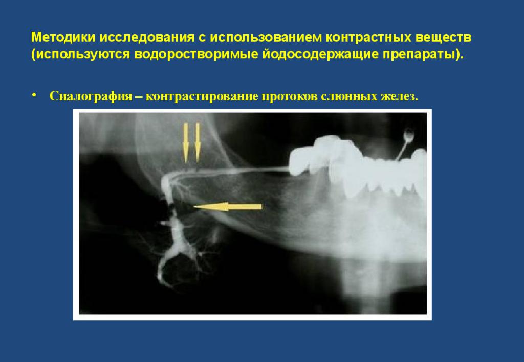 Сиалография слюнных