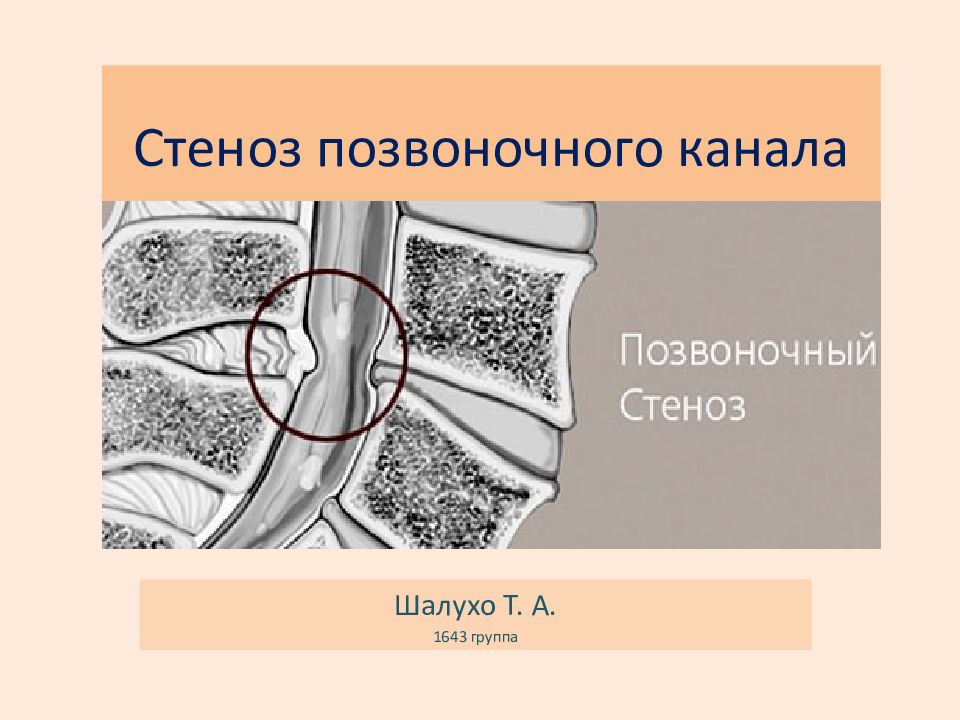 Формирование стеноза позвоночного канала