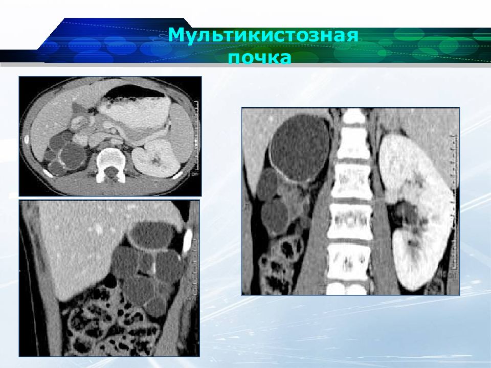 Дисплазия почки презентация