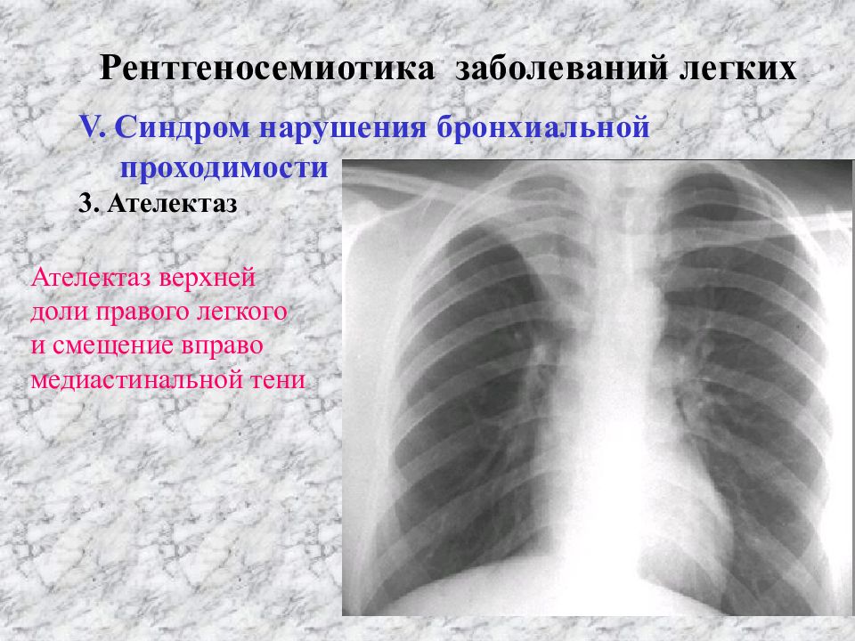 Рентгеновская картина нарушений бронхиальной проходимости