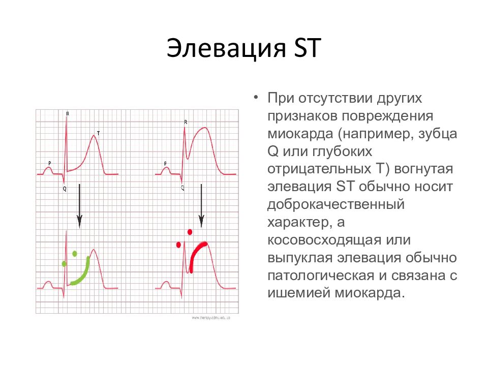 Конкордантный подъем сегмента. Элевация сегмента St на ЭКГ v2 v3. Элевация зубца т на ЭКГ. Элевация сегмента St при инфаркте миокарда. Косовосходящая элевация St.