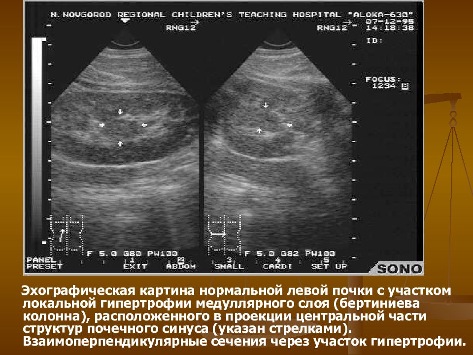 Эхографическая картина почек