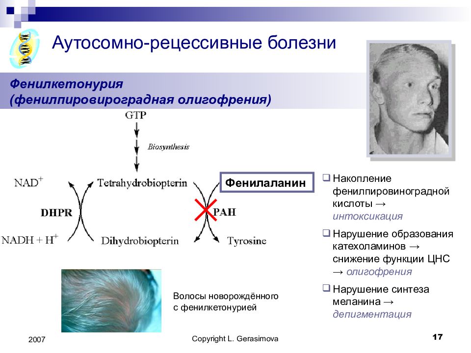 Болезнь фенилкетонурия презентация