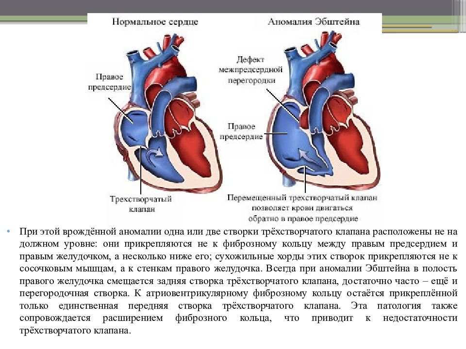 При аномалии эбштейна легочный рисунок