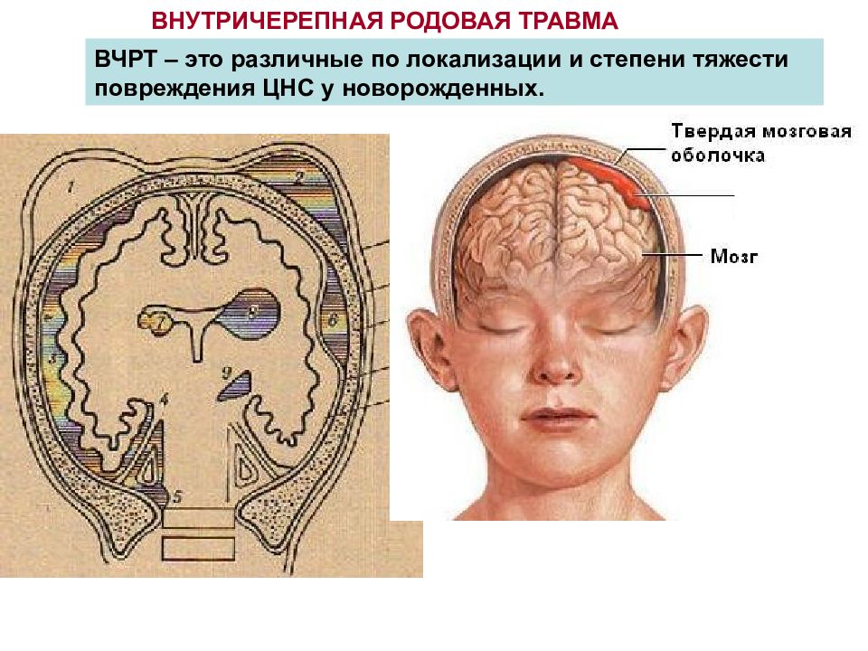 Травма нервной системы презентация