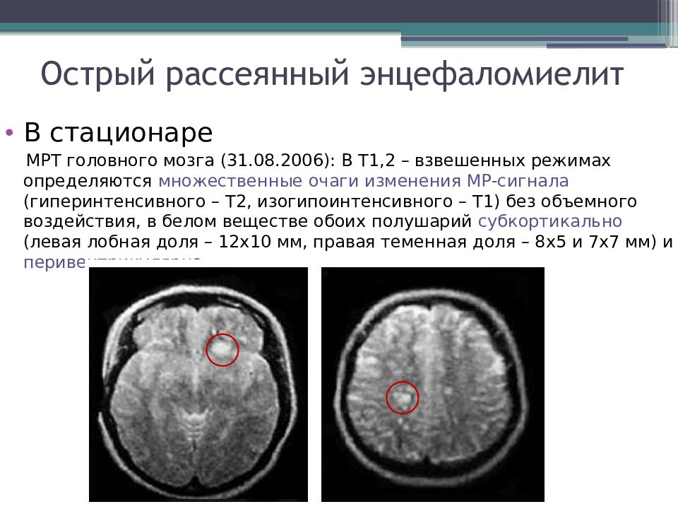 Острый рассеянный энцефаломиелит презентация