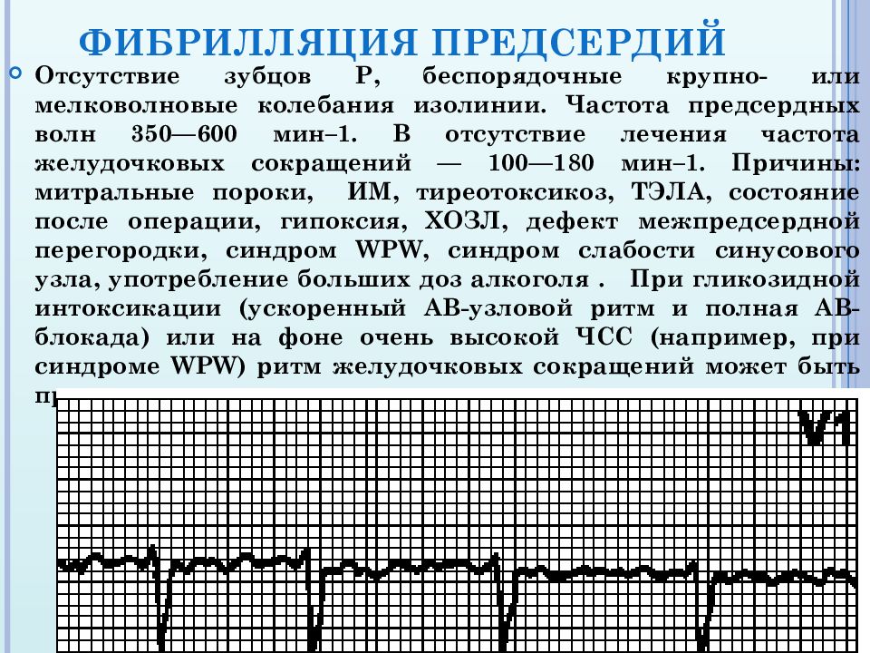 Трепетание предсердий причины. Фибрилляция и трепетание предсердий. Формы фибрилляции предсердий. Трепетание предсердий 2 к 1 на ЭКГ. Трепетание предсердий правильная форма.