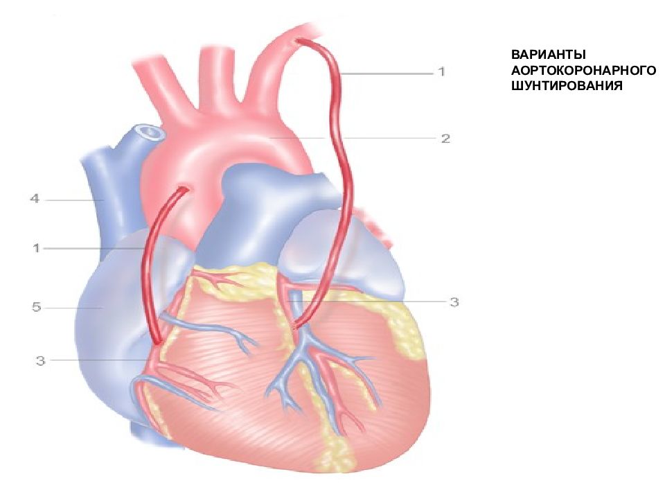 Что такое шунтирование сердца и сосудов. Аортокоронарное шунтирование сердца. Коронарное шунтирование сосудов сердца. Схема операции аортокоронарного шунтирования. Аорта коронарное шунтирование.