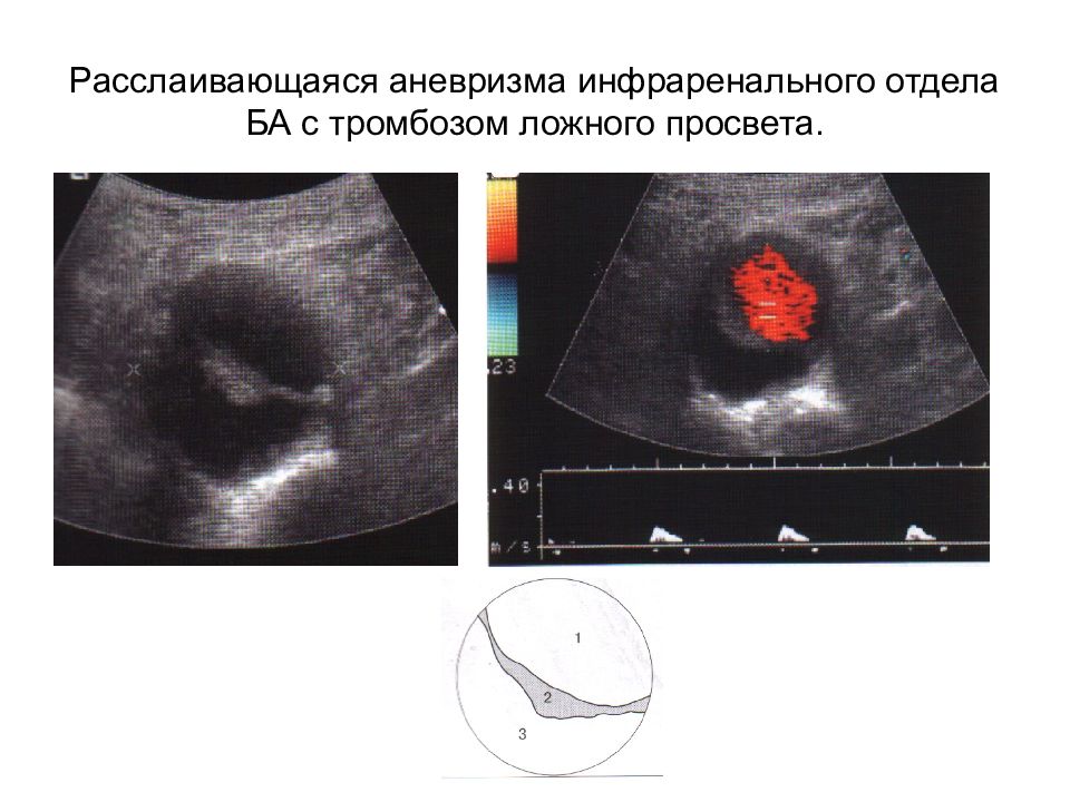 Аневризма аорты узи. Расслаивающая аневризма аорты УЗИ. Аневризма инфраренального отдела. Расслаивающаяся аневризма бедренной артерии.