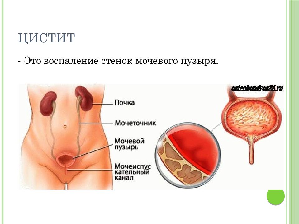 Хронический цистит презентация