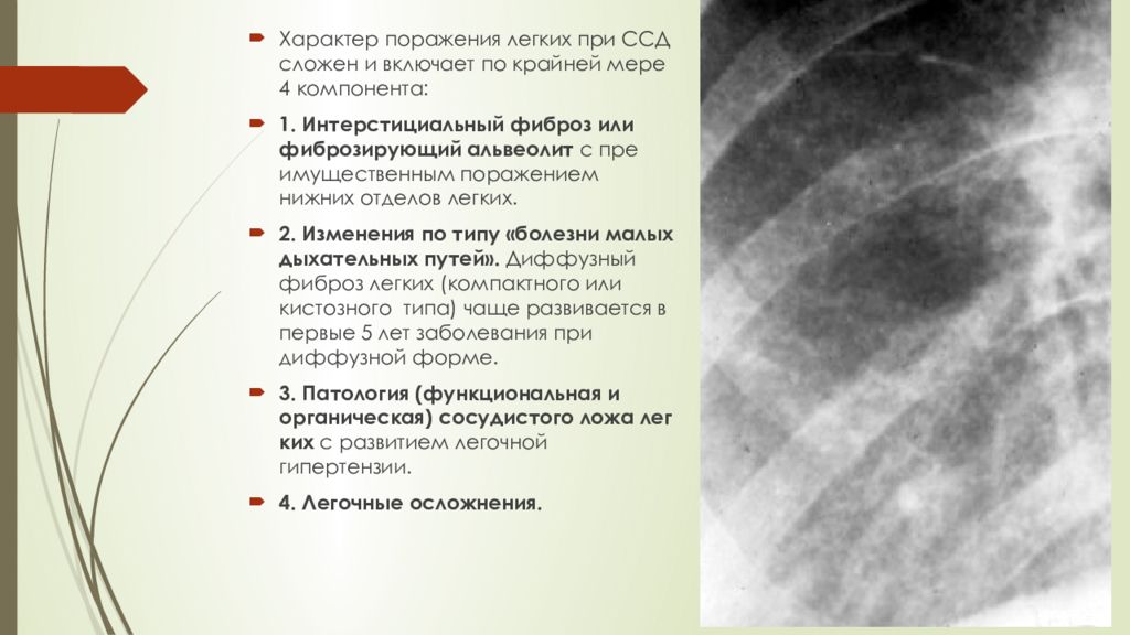 Последствия фиброза. Поражение легких при системной склеродермии. Склеродермия легких на кт. Интерстициальные заболевания легких рентген. Системная склеродермия поражение легких кт.