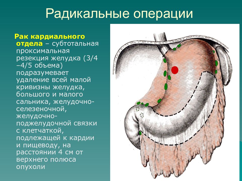 Рак желудка операция. Субтотальная резекция желудка. Проксимальная субтотальная резекция. Проксимальная резекция желудка. Субтотальная резекция дистальная и проксимальная.