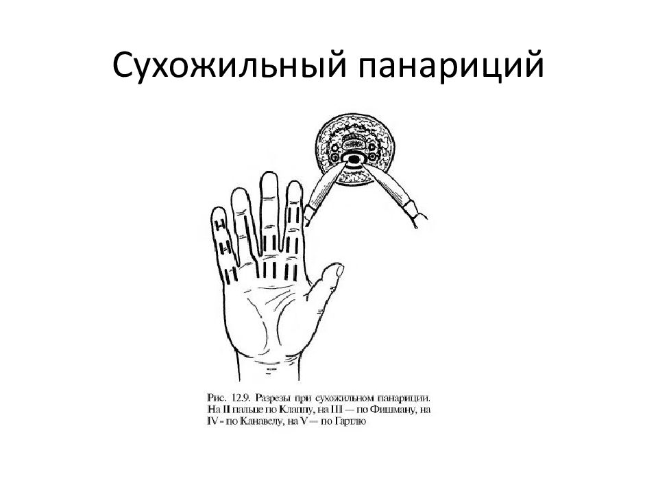 Классификация панарициев. Разрезы при подкожном панариции. Разрезы при тендовагинитах. Сухожильный панариций фото.