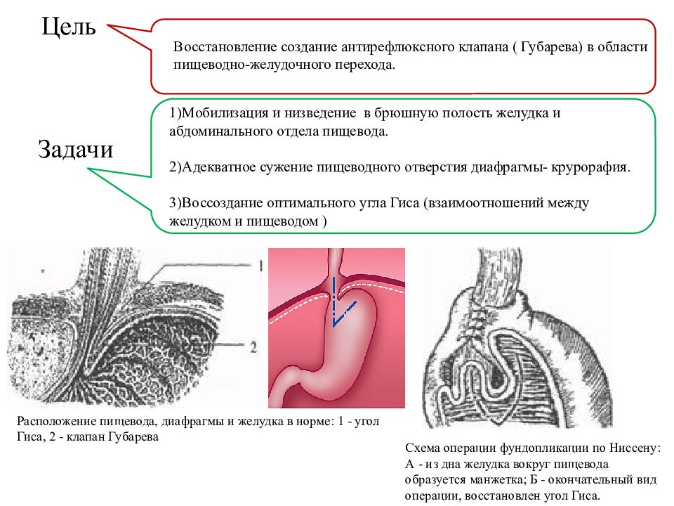 Диафрагмальные грыжи презентация хирургия