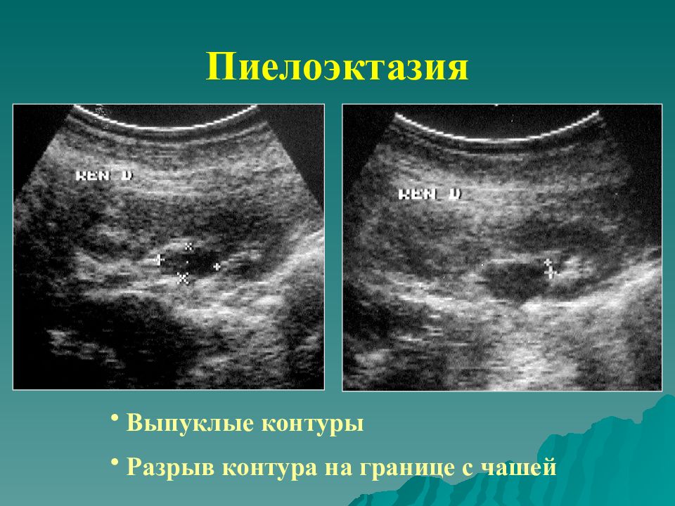 Пиелоэктазия у детей. Пиелоэктазия УЗИ. Пиелоэктазия почек на УЗИ. Степени пиелоэктазии.