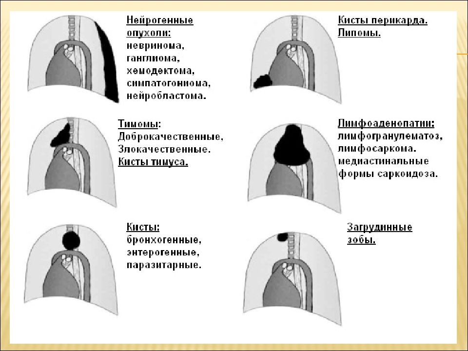 Образования средостения схема