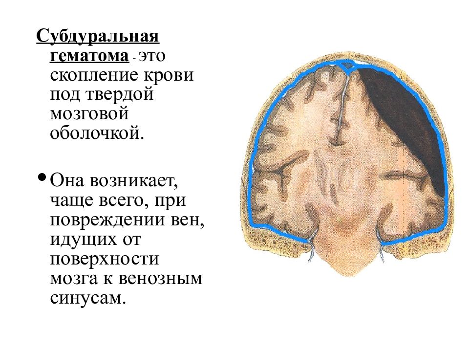 Гематома мозга операция