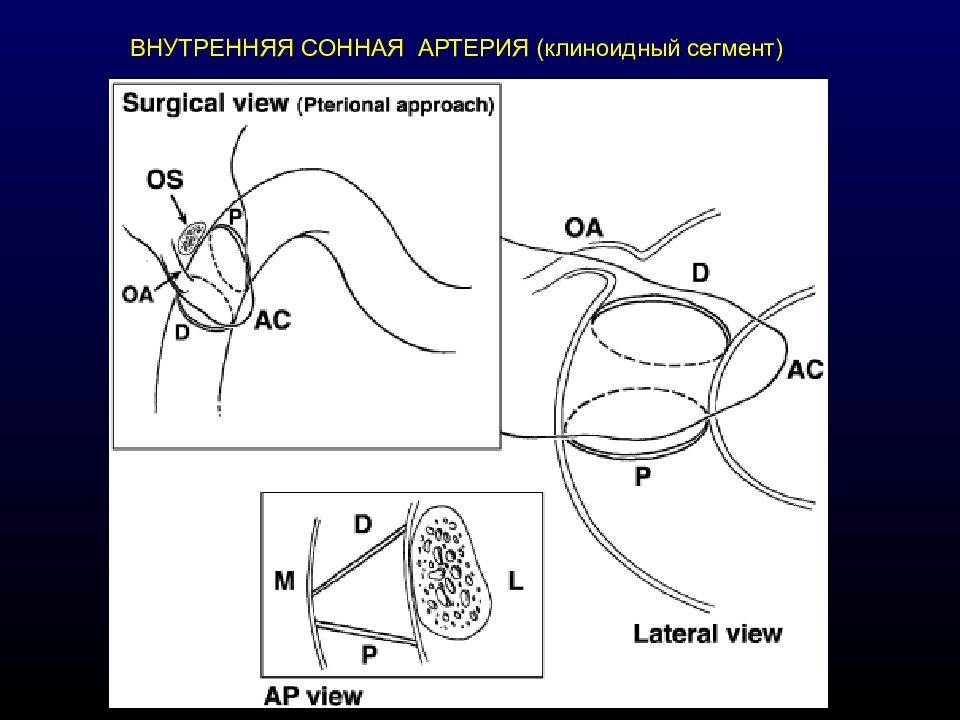 Сегмент артерии. Сегменты внутренней сонной артерии. Сегменты сонной артерии схема. Сегменты внутренней сонной артерии схема. Анатомия ВСА сегменты.