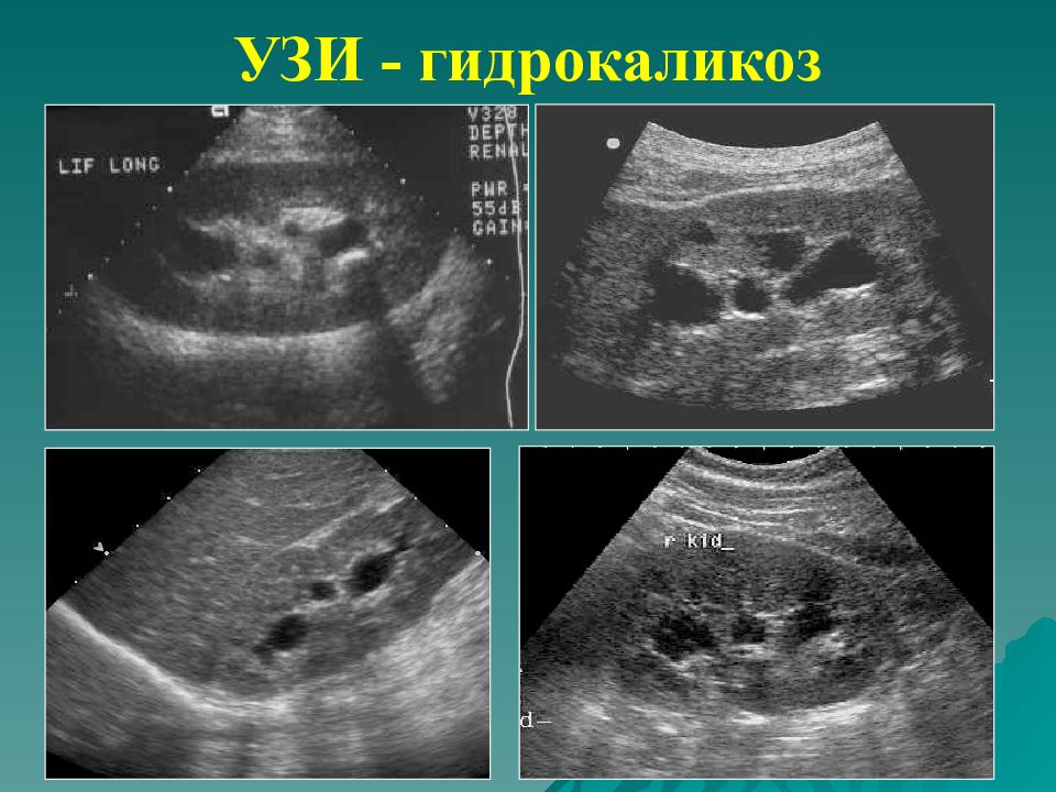 Каликоэктазия почек. Каликоэктазия почек на УЗИ. Терминальный гидронефроз почки УЗИ. Гидрокаликоз почек на УЗИ. Каликоэктазия левой почки на УЗИ.