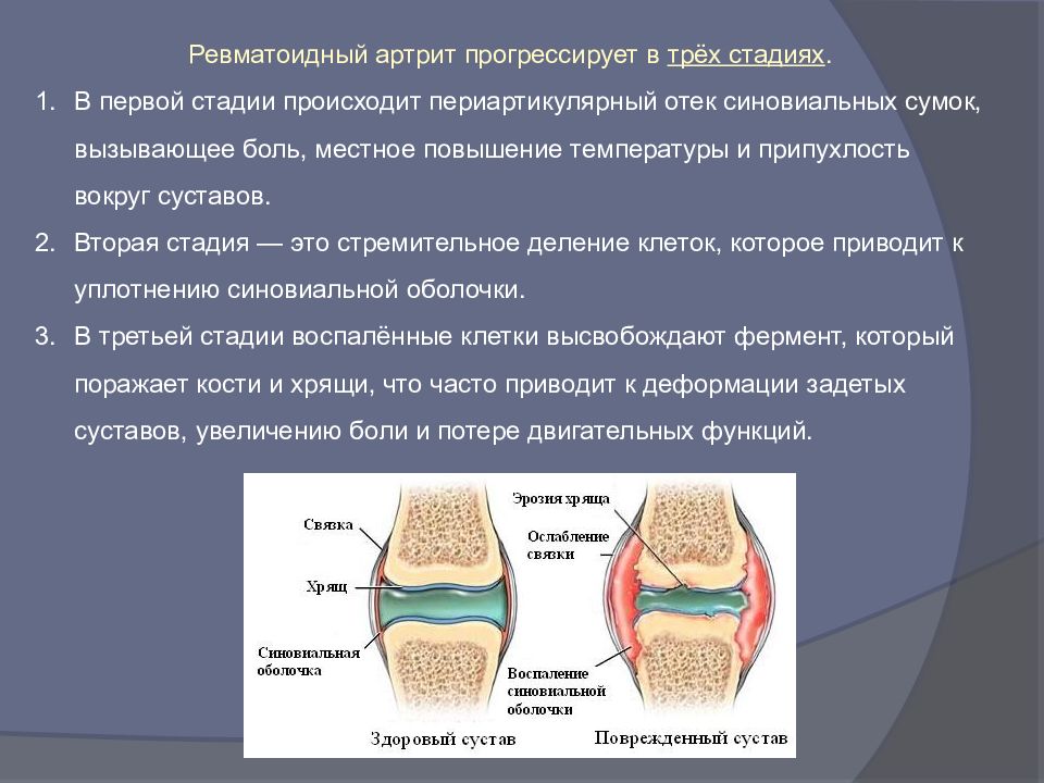 Ревматоидты артрит презентация