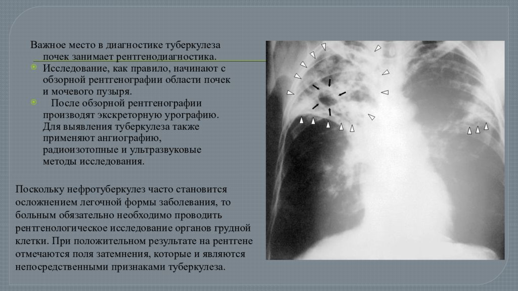 Туберкулез мочевой системы. Кавернозный туберкулез почки экскреторная урография. Туберкулез почек рентгенодиагностика. Рентгенологическая картина туберкулеза почки. Поликавернозный туберкулез почки.
