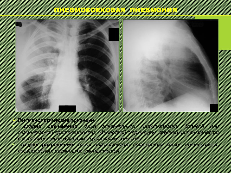 Пневмония диагностика