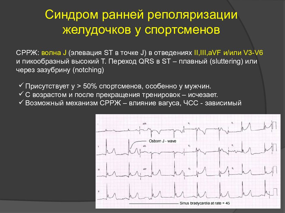 Умеренные изменения реполяризации. Ранняя реполяризация желудочков сердца на ЭКГ. Ранняя реполяризация желудочков на ЭКГ. Синдром реполяризации желудочков на ЭКГ что это такое. ЭКГ признаки синдрома ранней реполяризации желудочков.