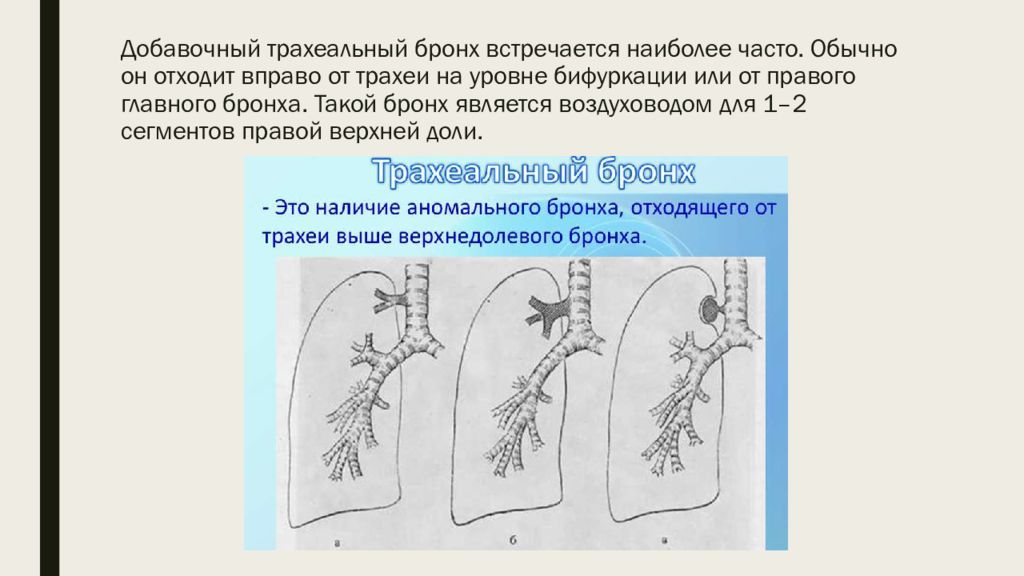 Пороки Развития Трахеи