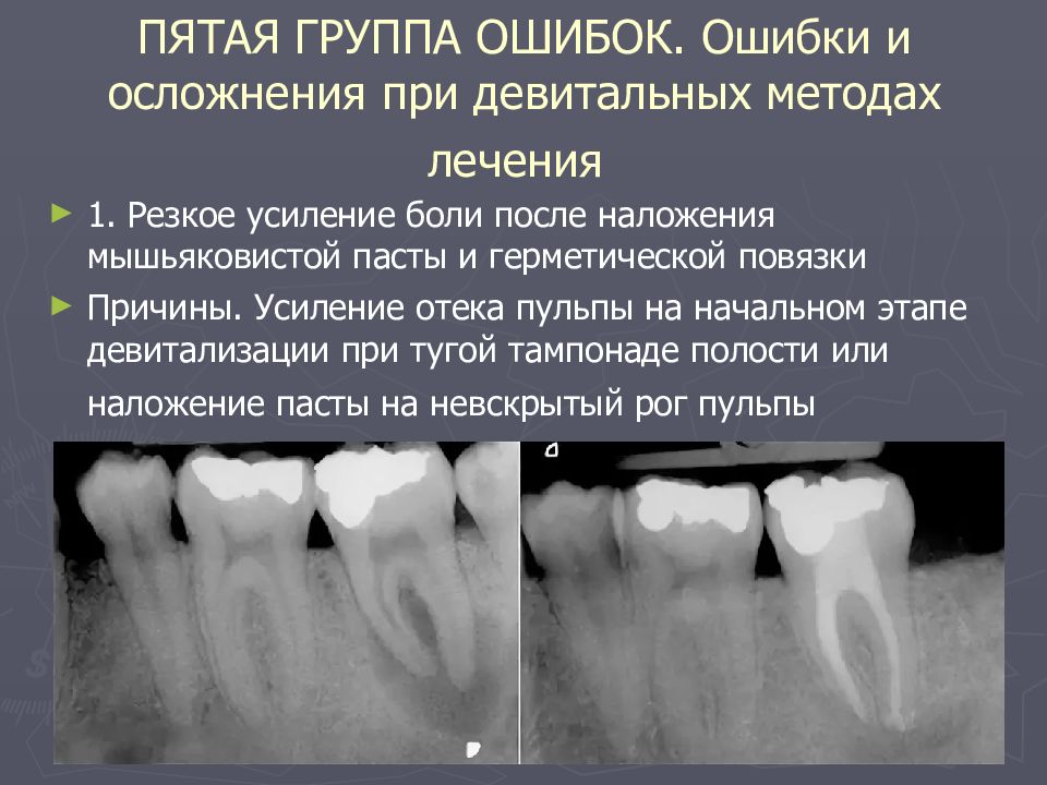 Ошибки и осложнения при диагностике и лечении пульпита презентация