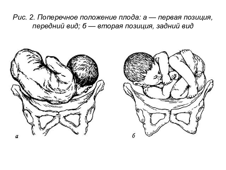 Передний вид предлежания. Ягодичное предлежание 2 позиция. Тазовое предлежание 2 позиция. Вторая позиция передний вид. Первая позиция передний вид.