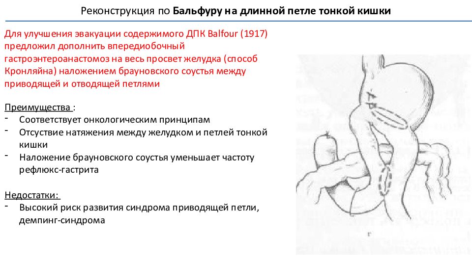 Резекция желудка по бальфуру схема