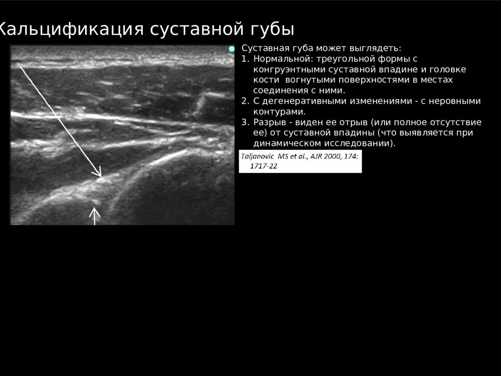 УЗИ плечевого сустава норма. УЗИ плечевого сустава методика исследования. УЗИ плечевого сустава лекция. УЗИ плечевого сустава пособие.